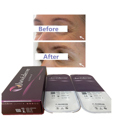 2ml Injections Hyaluronic Acid Facial Filler Juvederm Anti Wrinkle Filler