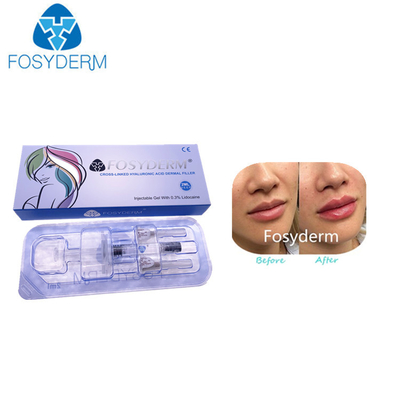 Korea Hyaluronic Acid Dermal Filler For Lip Augmentation Injection