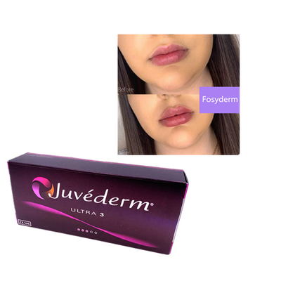 2ml Juvederm Hyaluronic Acid Dermal Filler Wrinkle Filler Chin Lips Ultra 3